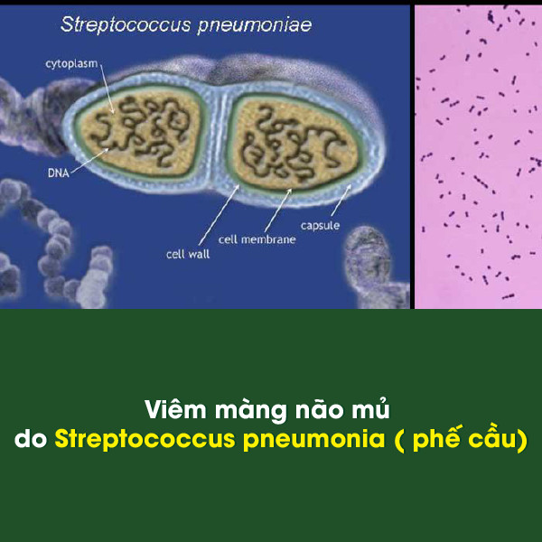  viêm màng não mủ do Streptococcus pneumonia ( phế cầu)