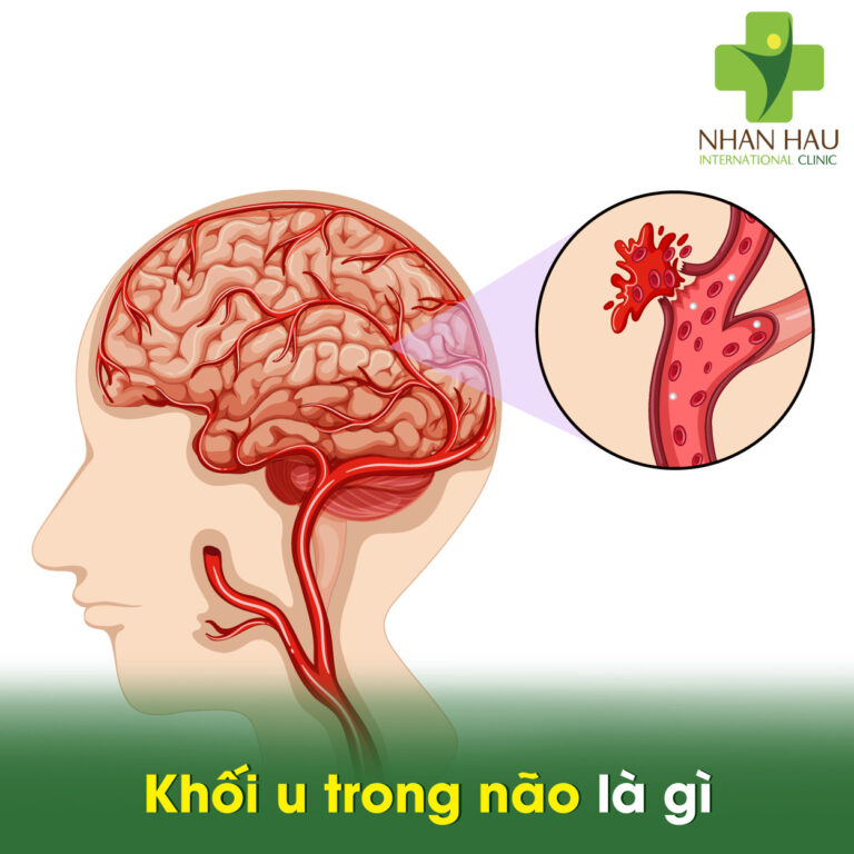 Khối u trong não là gì