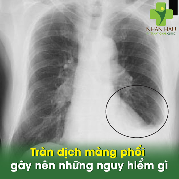 Tràn dịch màng phổi gây nên những nguy hiểm gì