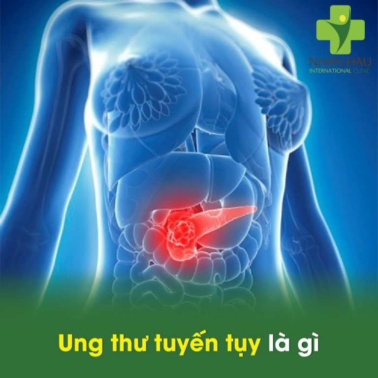 Ung thư tuyến tụy là gì