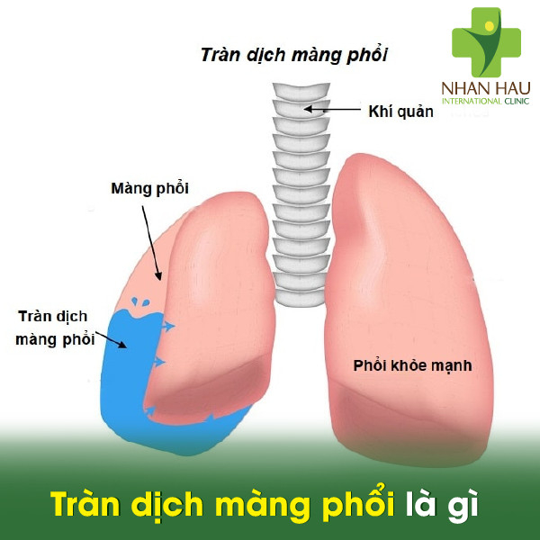 Tràn dịch màng phổi là gì
