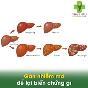 Gan nhiễm mỡ để lại biến chứng gì
