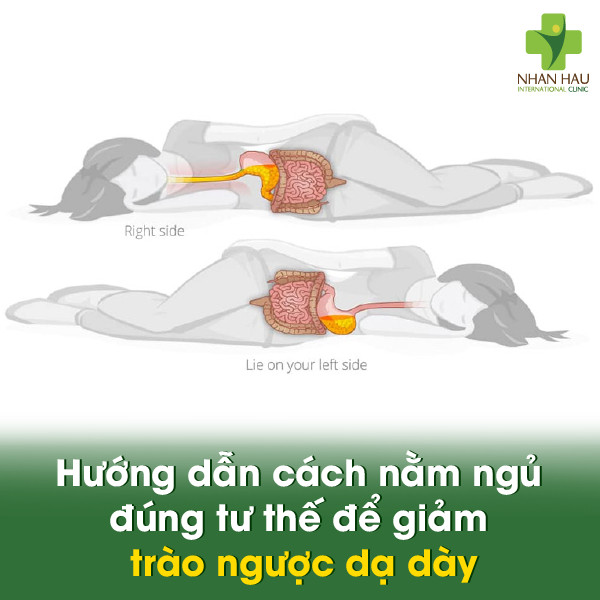 Hướng dẫn cách nằm ngủ đúng tư thế để giảm trào ngược dạ dày.
