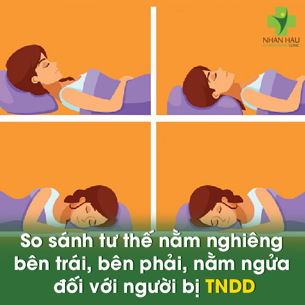 Nằm nghiêng bên trái - Cách ngủ đúng cho người bị trào ngược dạ dày 2 So sánh tư thế nằm nghiêng bên trái, bên phải, nằm ngửa đối với người bị trào ngược dạ dày