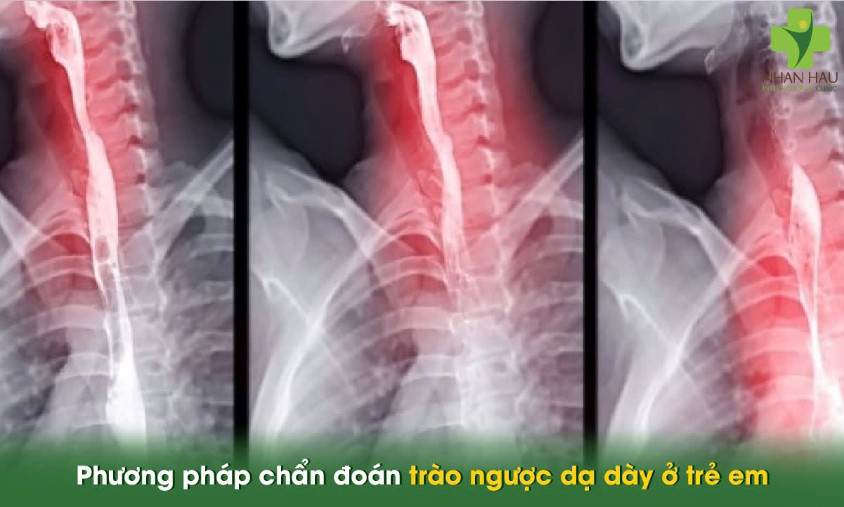 Trào ngược dạ dày ở trẻ em: Nguyên nhân, triệu chứng và cách điều trị nhanh tại nhà 5 Phương pháp chẩn đoán trào ngược dạ dày ở trẻ em