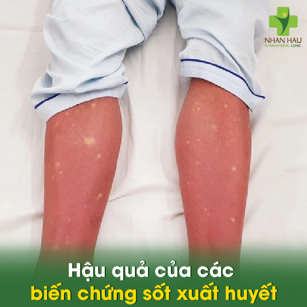 Biến chứng sốt xuất huyết: Hậu quả đáng lo ngại 7 Hậu quả của các biến chứng sốt xuất huyết