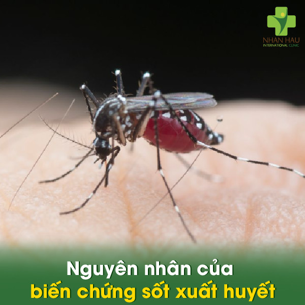 Biến chứng sốt xuất huyết: Hậu quả đáng lo ngại 6 Nguyên nhân của biến chứng sốt xuất huyết