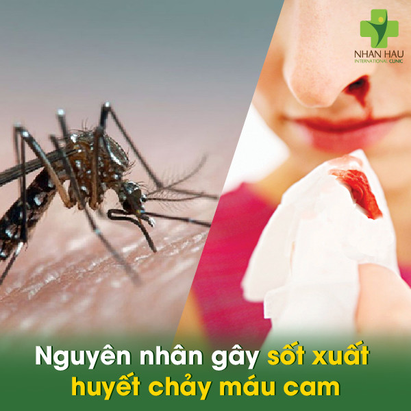 Nguyên nhân gây sốt xuất huyết chảy máu cam