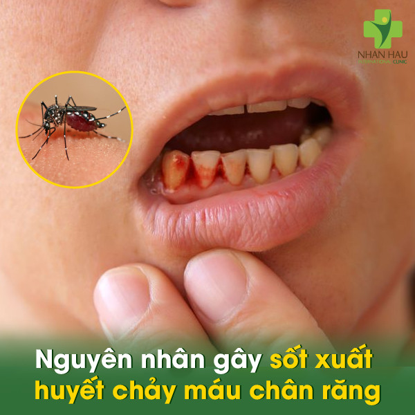 Nguyên nhân gây sốt xuất huyết chảy máu chân răng