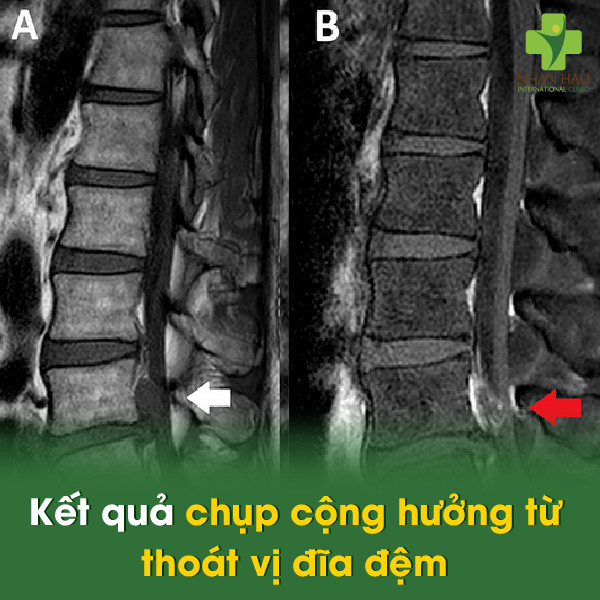 Chụp cộng hưởng từ thoát vị đĩa đệm: Chẩn đoán chính xác hỗ trợ điều trị hiệu quả 4 Kết quả chụp cộng hưởng từ thoát vị đĩa đệm
