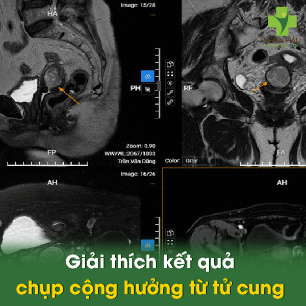 Giải thích kết quả chụp cộng hưởng từ tử cung