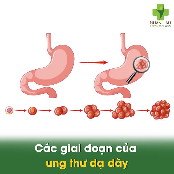 Các giai đoạn của ung thư dạ dày