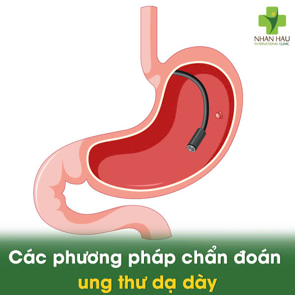 Các phương pháp chẩn đoán ung thư dạ dày