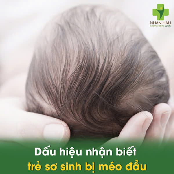 Dấu hiệu nhận biết trẻ sơ sinh bị méo đầu