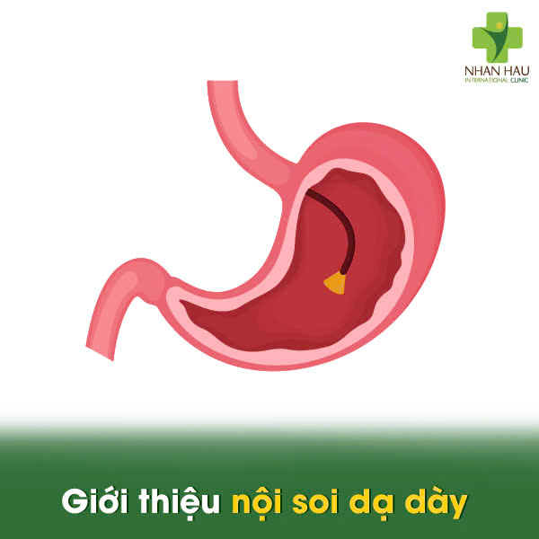 Giới thiệu nội soi dạ dày