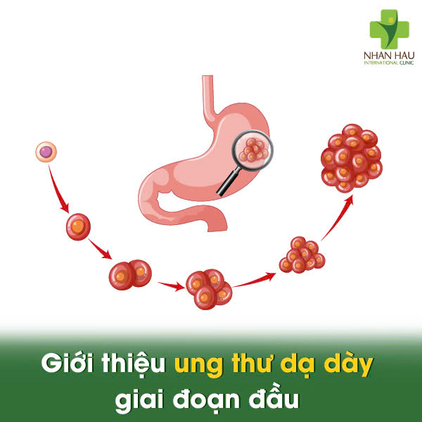 Giới thiệu ung thư dạ dày giai đoạn đầu