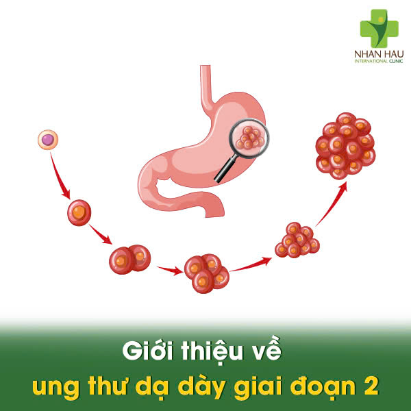 Giới thiệu về ung thư dạ dày giai đoạn 2