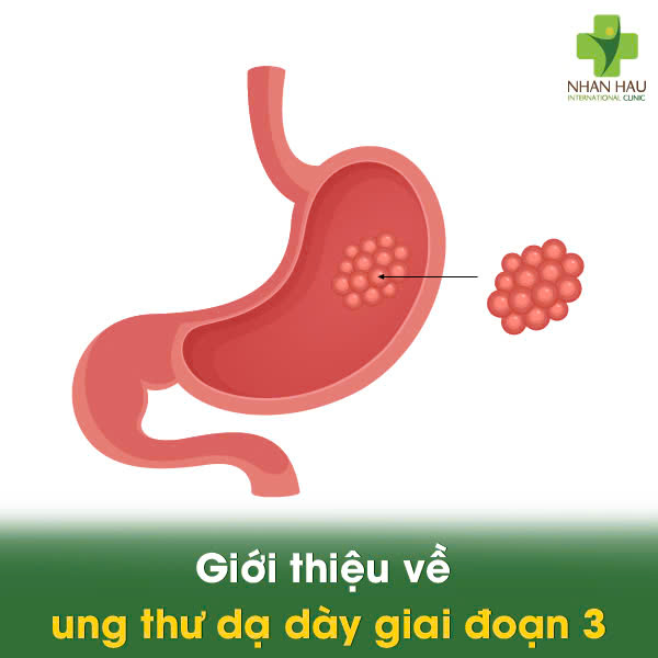 Giới thiệu về ung thư dạ dày giai đoạn 3