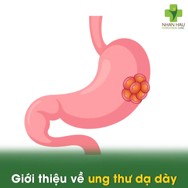 Giới thiệu về ung thư dạ dày