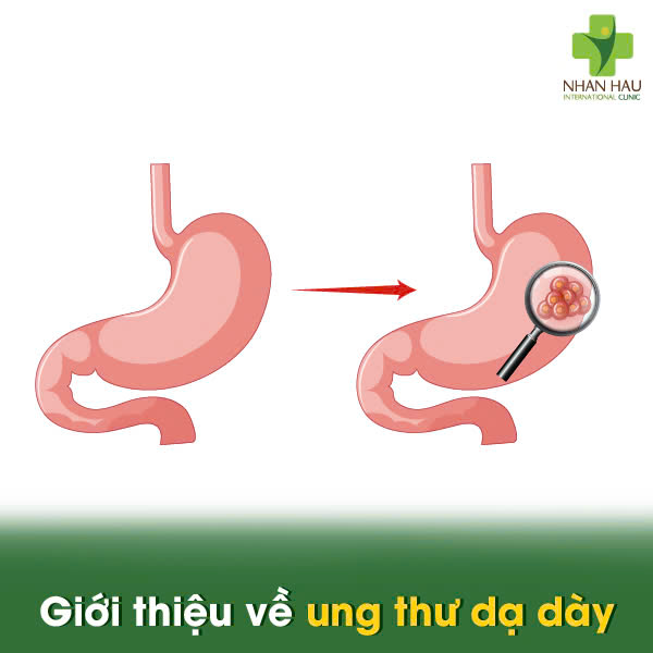 Giới thiệu về ung thư dạ dày