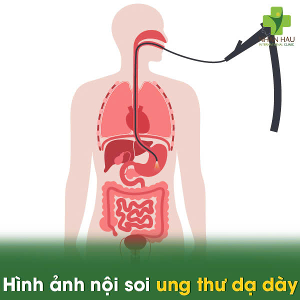 Hình ảnh nội soi ung thư dạ dày