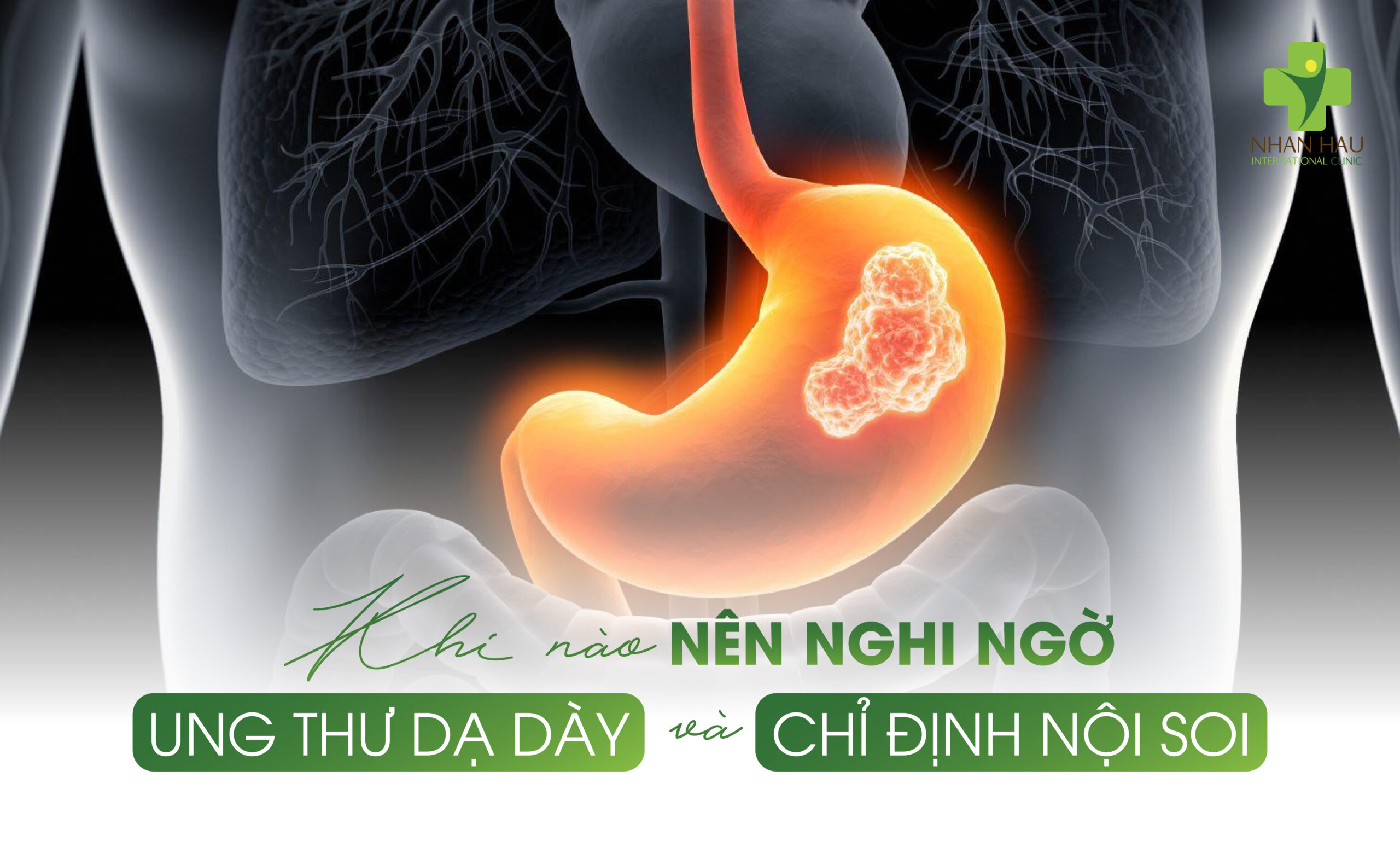 Nội Soi Dạ Dày Có Phát Hiện Ung Thư Dạ Dày Không? Giải Đáp Toàn Diện Từ Chuyên Gia 7 Khi Nào Nên Nghi Ngờ Ung Thư Dạ Dày Và Chỉ Định Nội Soi