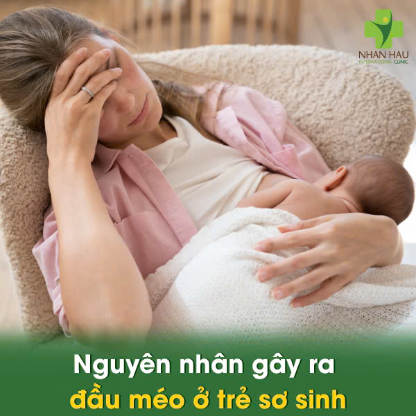 Nguyên nhân gây ra đầu méo ở trẻ sơ sinh