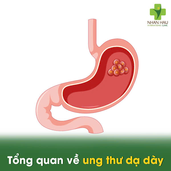 Tổng quan về ung thư dạ dày