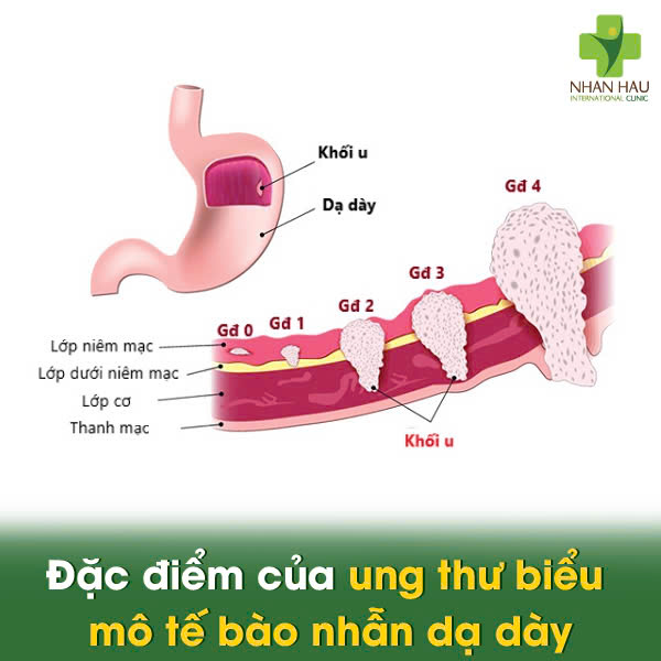 Đặc điểm của ung thư biểu mô tế bào nhẫn dạ dày