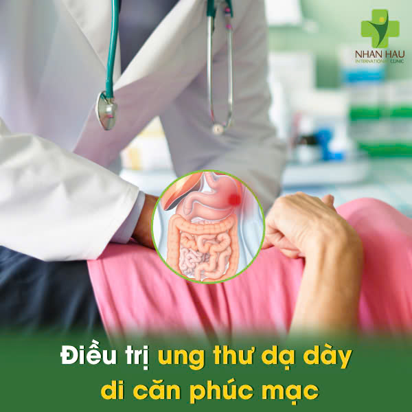 Điều trị ung thư dạ dày di căn phúc mạc