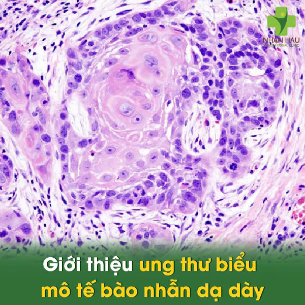 Ung Thư Biểu Mô Tế Bào Nhẫn Dạ Dày: Hiếm gặp nhưng cần cảnh giác! 1 Giới thiệu Ung Thư Biểu Mô Tế Bào Nhẫn Dạ Dày