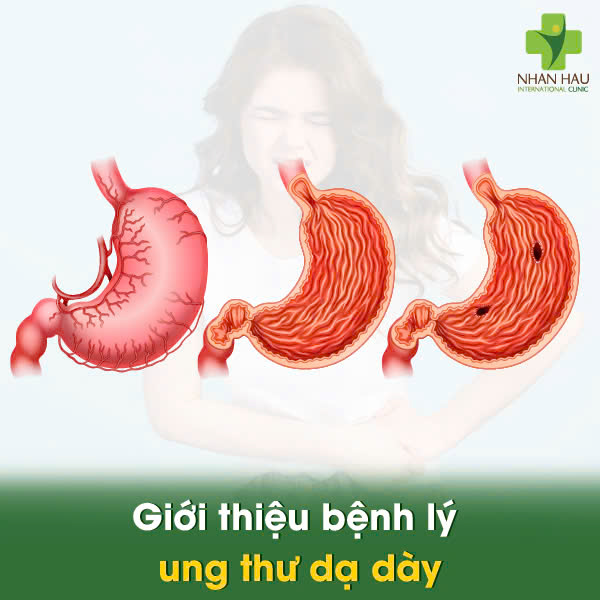 Giới thiệu bệnh lý ung thư dạ dày