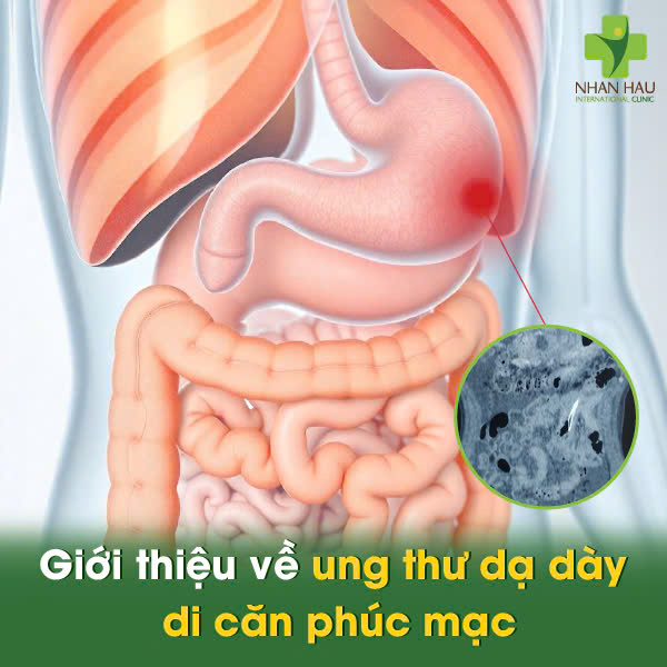 Ung Thư Dạ Dày Di Căn Phúc Mạc: Triệu Chứng, Điều Trị và Cách Chăm Sóc Người Bệnh 1 Giới thiệu về Ung Thư Dạ Dày Di Căn Phúc Mạc