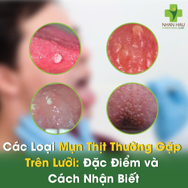 Các Loại Mụn Thịt Thường Gặp Trên Lưỡi: Đặc Điểm và Cách Nhận Biết