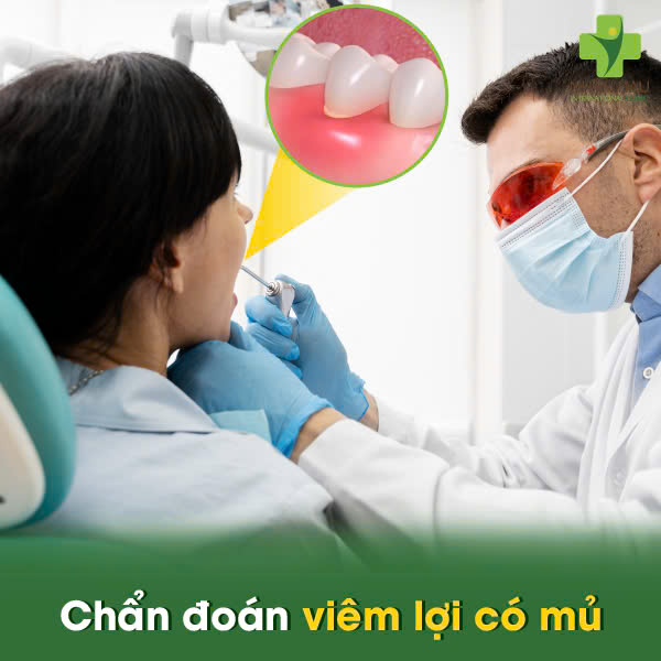 Chẩn đoán viêm lợi có mủ