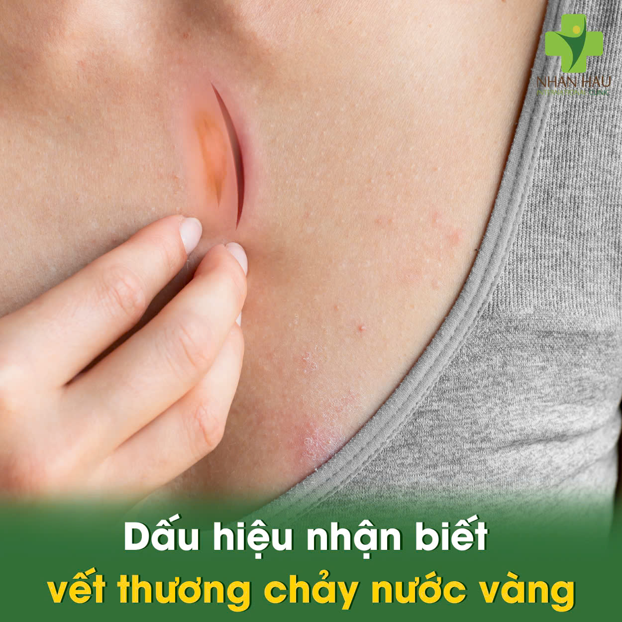 Dấu hiệu nhận biết vết thương chảy nước vàng