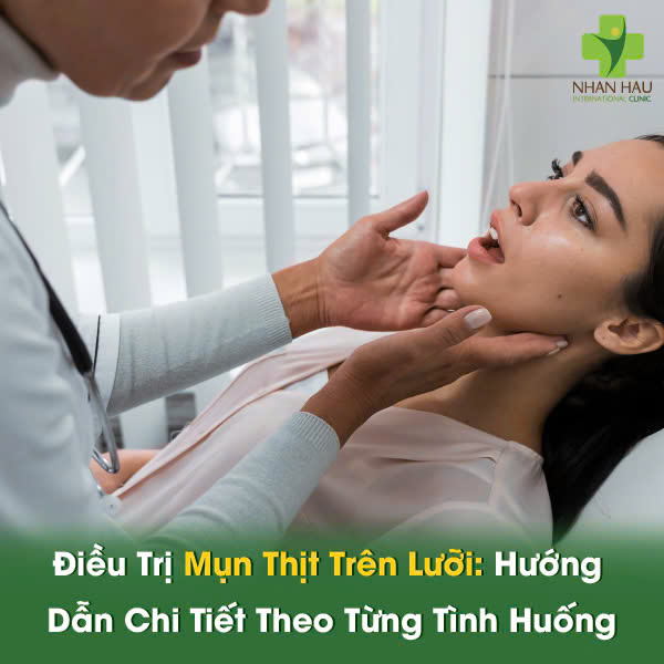 Điều Trị Mụn Thịt Trên Lưỡi: Hướng Dẫn Chi Tiết Theo Từng Tình Huống