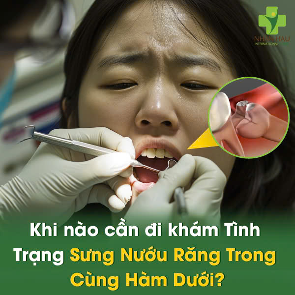 Khi nào cần đi khám Tình Trạng Sưng Nướu Răng Trong Cùng Hàm Dưới?