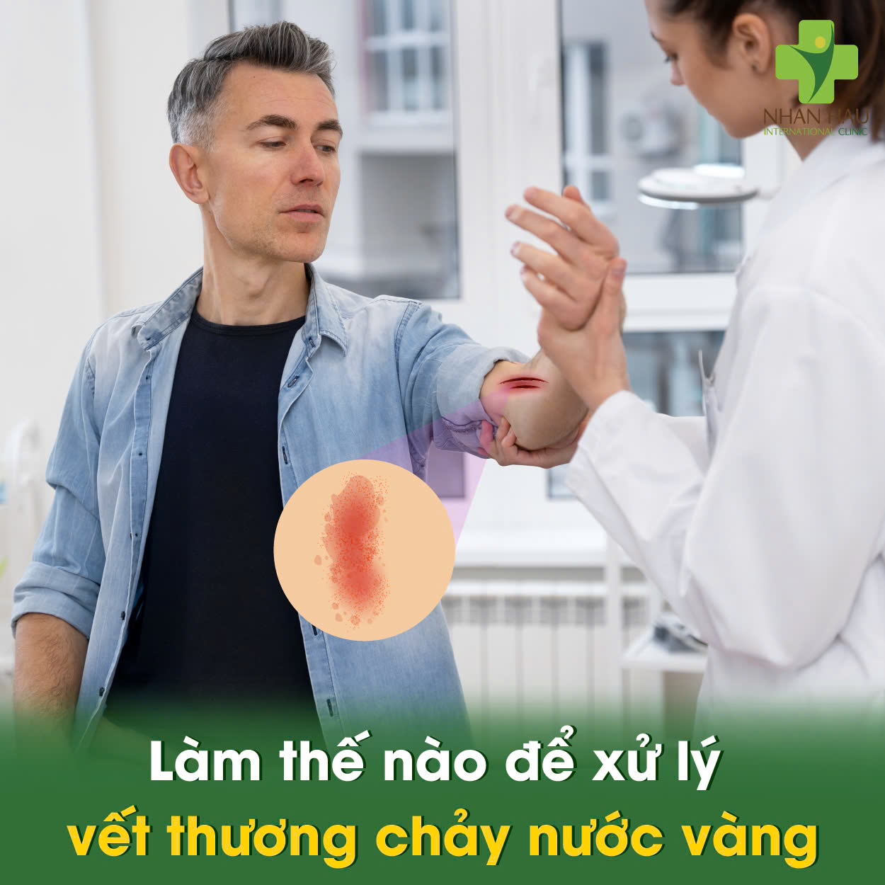 Làm thế nào để xử lý vết thương chảy nước vàng