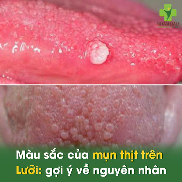 Màu Sắc Của Mụn Thịt Trên Lưỡi: Gợi Ý Về Nguyên Nhân