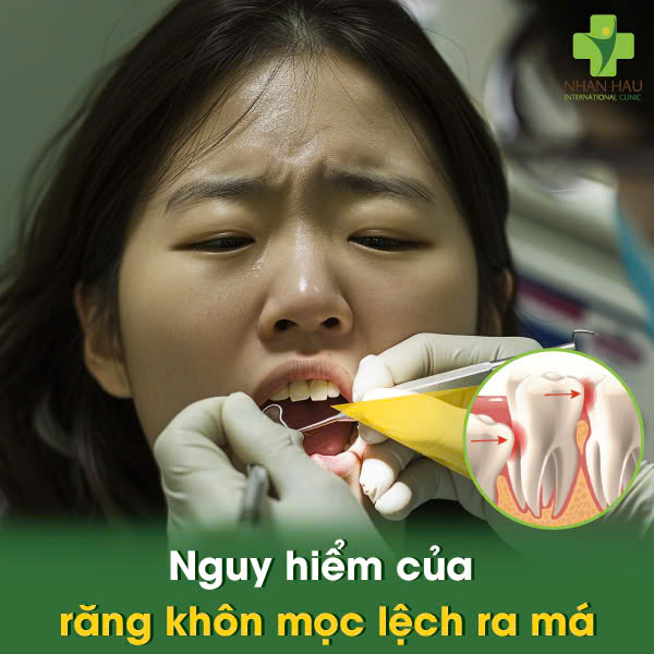 Nguy hiểm của răng khôn mọc lệch ra má