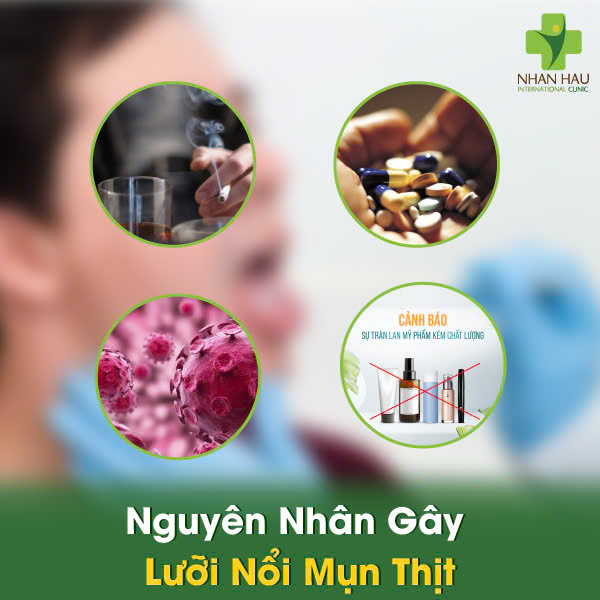 Nguyên Nhân Gây Lưỡi Nổi Mụn Thịt