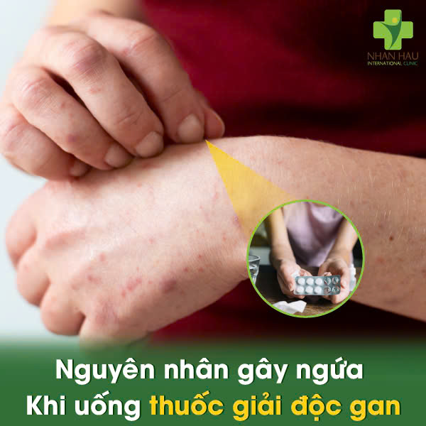 Nguyên Nhân Gây Ngứa Khi Uống Thuốc Giải Độc Gan