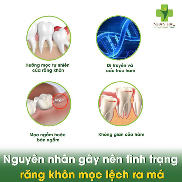 Nguyên nhân gây nên tình trạng răng khôn mọc lệch ra má