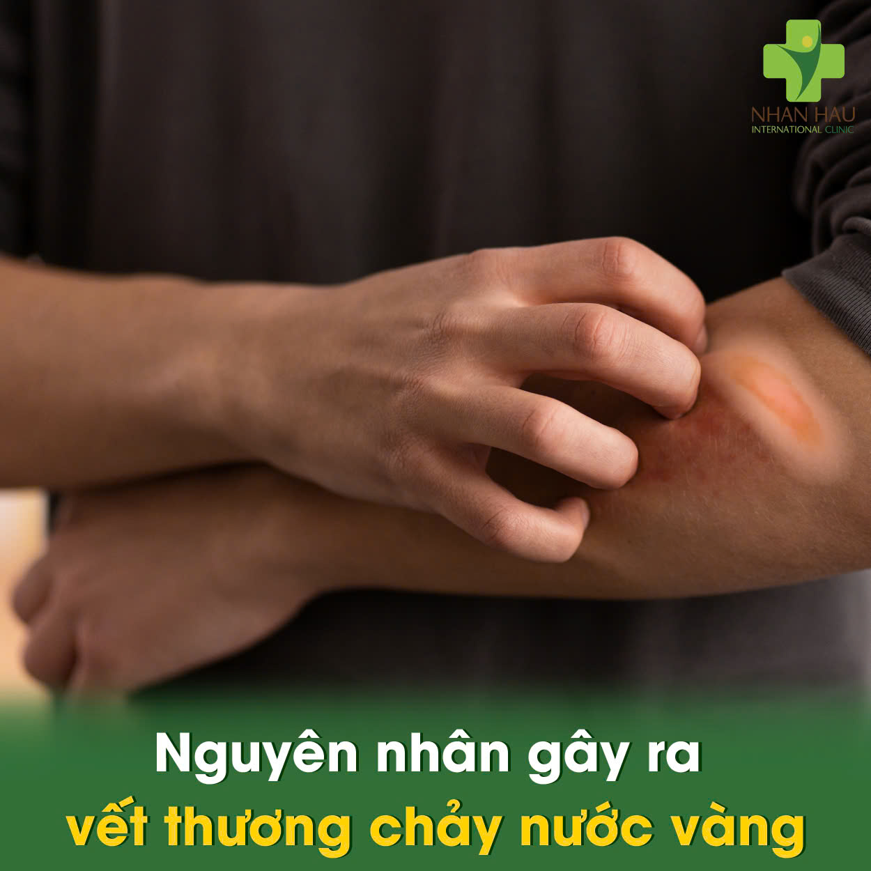 Nguyên nhân gây ra vết thương chảy nước vàng