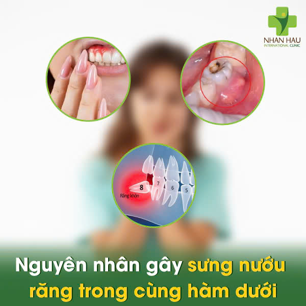 Nguyên nhân gây sưng nướu răng trong cùng hàm dưới