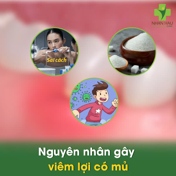 Nguyên nhân gây viêm lợi có mủ