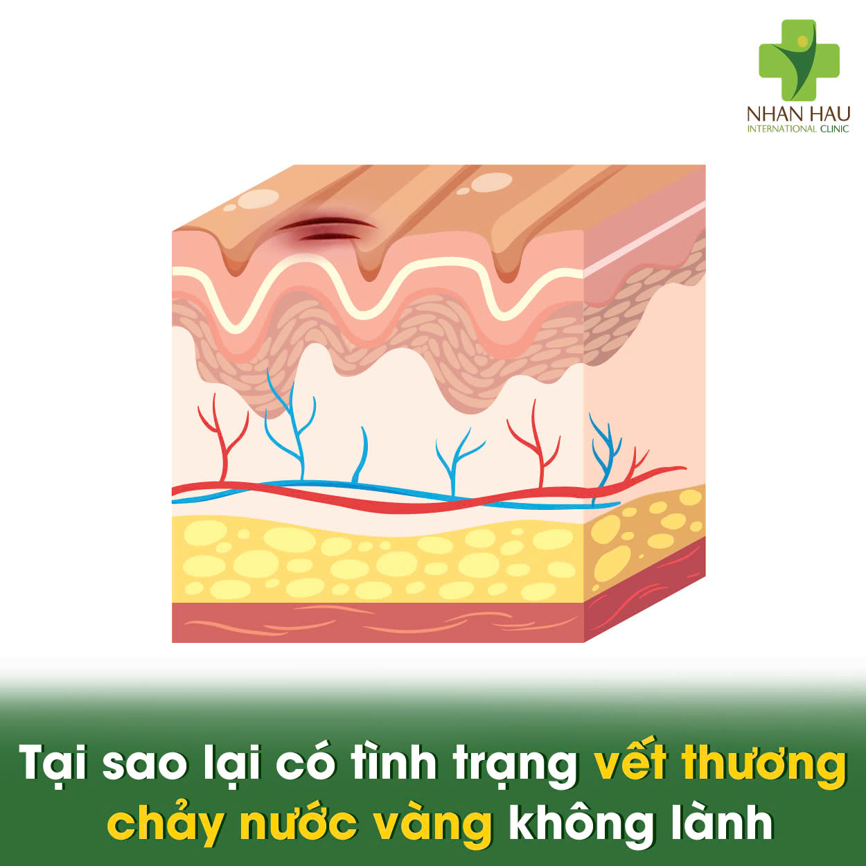 Tại sao vết thương bị chảy nước vàng?