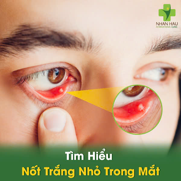 Tìm Hiểu Nốt Trắng Nhỏ Trong Mắt