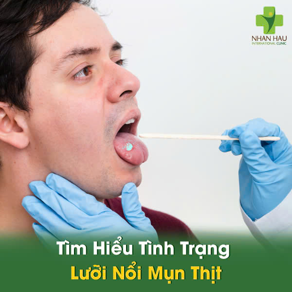 Tìm Hiểu Tình Trạng Lưỡi Nổi Mụn Thịt